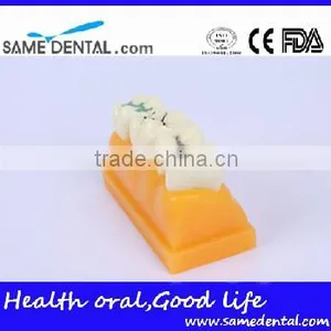 Pit and Fissure Model Dental Eduction Assitant No. DEA-19 thumbnail-2
