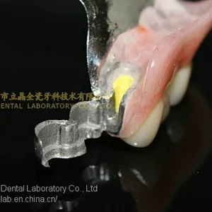 Dental Precision Attachment, Dental Attachment, Dental Denture, Laboratoire Dentaire, Dentallabor, Laboratorio Dental, Dental Laboratory, Shenzhen LJ Dental Lab China thumbnail-1