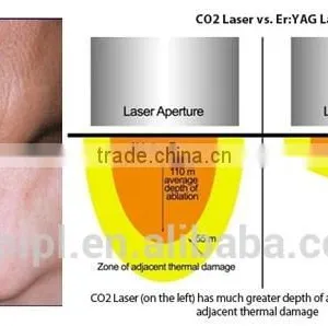 RF Co2 Fractional Laser Fractional Laser Treatment thumbnail-3