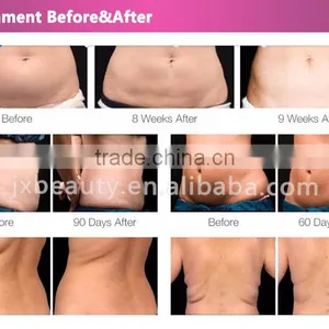 Liposuction Ultrasonic Machine That Remove Belly Fat thumbnail-6