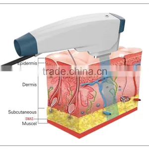 4MHZ Multifunctional Platform Hair Removal OPT High Frequency  SHR/ Face Lift Ultrasound HIFU Machine Forehead Wrinkle Removal thumbnail-2