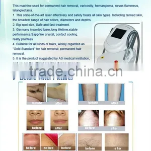 50-60HZ 808nm Diode Laser Unwanted Hair Permanent Hair Removal Machine 3000W thumbnail-4