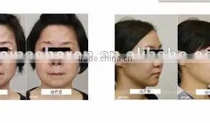 Protable Hifu Korea Face Lift/ Slimming Machine/ High Intensity Focused Untrasound thumbnail-4