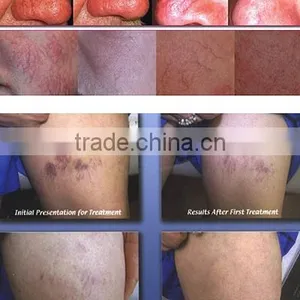 2016 Professional Mini High Frequency Spider Vein Removal/ Vascular Removal/thread Vein Removal thumbnail-6