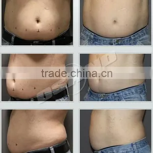 Protable 3 In1 Best Fat Reduce Slimming Lipo Laser and Cryolipolisis Criolipolisis thumbnail-6