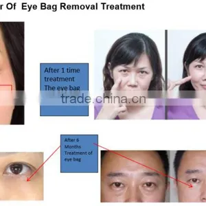 Beauty Machine Eye Care System for Eye Bag Removal for Wrinkle Removal thumbnail-4
