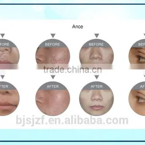 Carboxytherapy F5 Co2 RF/Glass Pipe Fractional Vagina Vascular Treatment Tightening Co2 Laser Equipment Anybeauty Original Manufacturer 10MHz thumbnail-6
