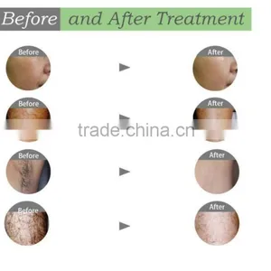Factory Price E-light+IPL SHR/Super Hair Removal/E-light IPL Laser Therapy Machine thumbnail-4