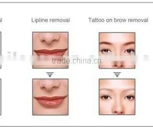 Top Good Quality Beauty Equipment for Wart Removal thumbnail-5