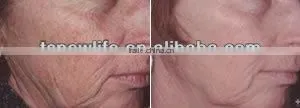 NL-RFC201 Portable Korea RF Facial And Body Tighten Beauty Equipment/Korea RF Facial And Body Tighten Beauty Equipment thumbnail-6