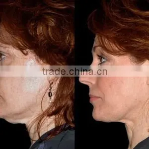 Monopolar Radio Frequency RF Skin/Beauty Salon Equipment RF & Us thumbnail-6
