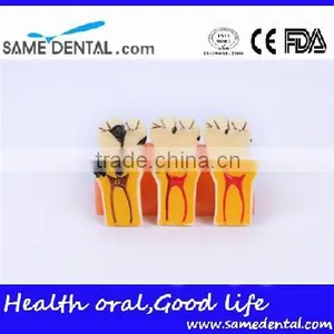 4 Times the Cavities Progress Model Dental Eduction Assitant No. DEA-16 thumbnail-4