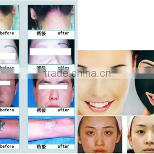 Freckles Removal Nd Yag Laser Tattoo Removal Machine/q-switched Nd Yag Laser/laser Hair Removal And Tattoo Removal Machine Haemangioma Treatment thumbnail-6