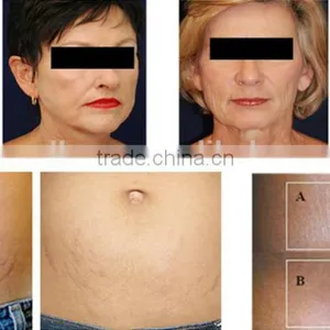 2016 Multipolar rf Ultrasonic Liposuction Cavitation Machine for Sale thumbnail-6