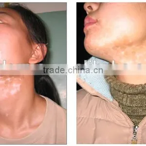 Hand Held NB UVB Phototherapy 311nm Lamp for Vitiligo Eczema Psoriasis thumbnail-1