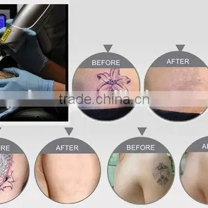 Facial Veins Treatment Low Price Q-Switched Nd:YAG Laser Tatoo Removal Machine By QTS Naevus Of Ito Removal thumbnail-4