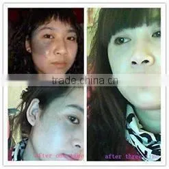 Sanhe Best Fractional Co2 Laser,fractional Co2 Laser Device,co2 Fractional Laser With Vaginal thumbnail-5