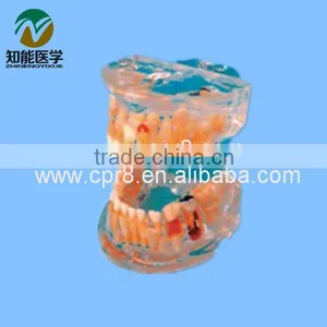 Transparent Baby Teeth Pathological Model BIX - L1006 thumbnail-1