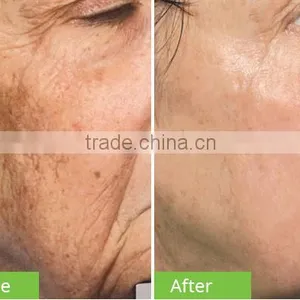 Portable Beauty Equipment Power Crystal Diamond Microdermabrasion Peeling and Jet Peel Machine thumbnail-6