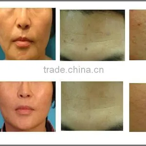 Distributor Wanted Portable rf Fractional Micro Needle Machine/fractional rf Micro Needle Device thumbnail-4