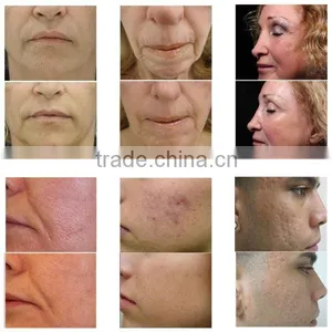 Professional Medical Clinic Home Use Best Fractional RF Micro Needle Wrinkle / Acne Scar Removal/ Skin Tightening Facial Machine thumbnail-2