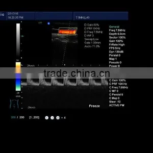 Portable Doppler Ultrasound Machine Color Doppler K10 thumbnail-3