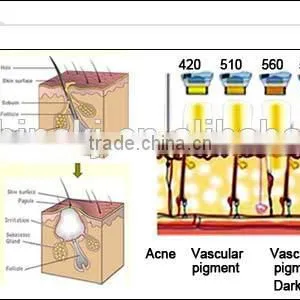 Painless Hair Removal and Acne Removal at Home Portable Machine for Sale thumbnail-2