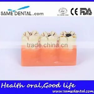 4 Times the Cavities Progress Model Dental Eduction Assitant No. DEA-16 thumbnail-2