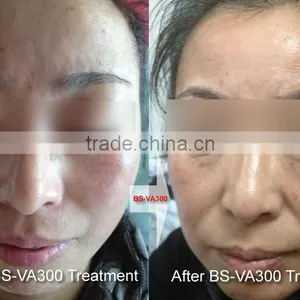 High Frequency Vascular Removal Red Spider thumbnail-5