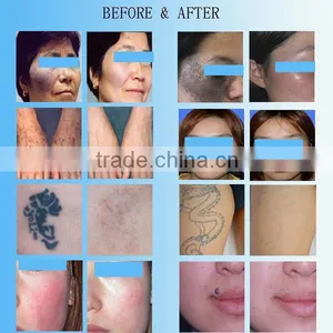 q Switched nd Yag Laser Handle Tattoo Removal Laser Instrument 1064 nm 532nm nd Yag Laser thumbnail-6