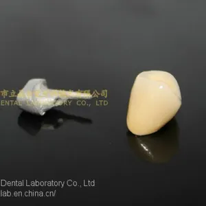 Dental Crown Porcelain Fused Metal, PFM, VMK, Dental Prostheses, Laboratoire Dentaire, Dentallabor, Laboratorio Dental, Dental Laboratory, Shenzhen LJ Dental Lab China thumbnail-5