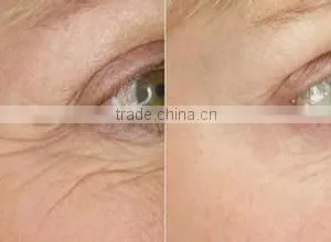 RF Facial Skin Tightening Machine/RF Radio Frequency Beauty Equipment thumbnail-6