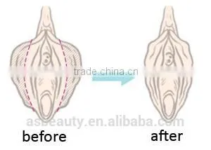 Warts Removal Medical Co2 Fractional Laser Machine/Vaginal 10600nm Carboxytherapy Tightening/ Vaginal Rejuvenation Machine Mole Removal thumbnail-5