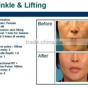2016 Factory Machine Wholesale Radio Frequency Wrinkle Removal Face Lift Skin Rejuvenation and Acne Scar Clearance thumbnail-4