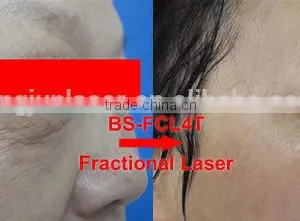 Professional Top Sell !! Laser Co2 Fractional Skin Resurfacing Machine Laser Skin Treatment Machine CE Wrinkle Removal thumbnail-2