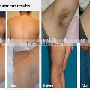 808nm Permanent Diode Laser Hair Removal Beauty Machine thumbnail-4