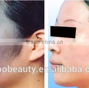 Varicose Veins Treatment 2017 New Design Vertical Q Switched Nd:yag Laser 1064&532nm For Pigmented Lesions Tattoo Removal Machine 532nm thumbnail-6