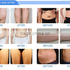 Fat Melting Cryolipolysis Machine For Sale / Vertical Chinese Factory Price Cryolipolysis For Salon Slimming Reshaping thumbnail-5