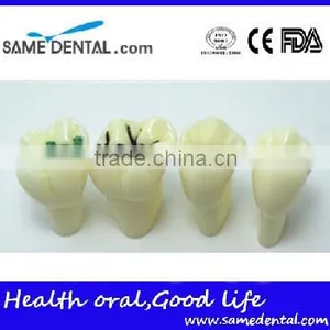 Pit and Fissure Model Dental Eduction Assistant No. DEA-19 thumbnail-3