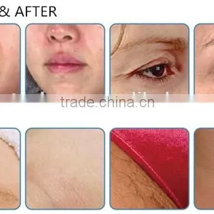 Manufacture HIFRF Beauty Machine Radio Frequency Aesthetics thumbnail-5