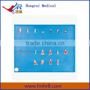 Hot Sale Dental Teeth Diseases Model thumbnail-1