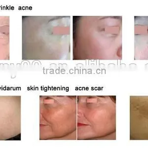 2013 Hot Sale!! Fractional Co2 Laser For Surgical Scar Removal thumbnail-2