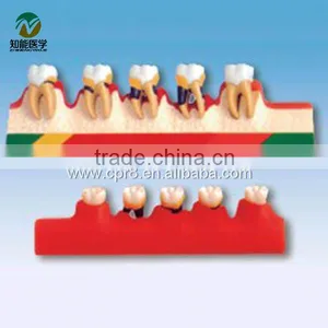 BIX-L1010 Periodontal Disease Model thumbnail-1