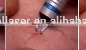 2016 Hot Selling Mini 15W Vasscular Removal Beauty Equipment 980 Laser Spider Machine thumbnail-4