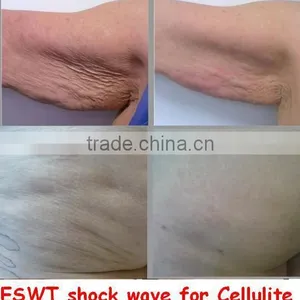 IShock Pro Hot Sale Acoustic Wave Therapy Body Machine Portable thumbnail-5
