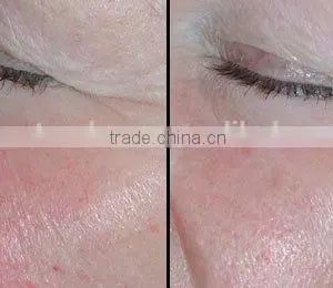 Hot Sale New Year Spider Veins/ Spider Vein Laser/ Spider Vein Removal Machine thumbnail-4