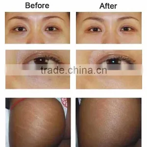 CO2 Carboxytherapy Machine , Carboxy Therapy Machine ,carboxtherapy Equipment VM102 thumbnail-3