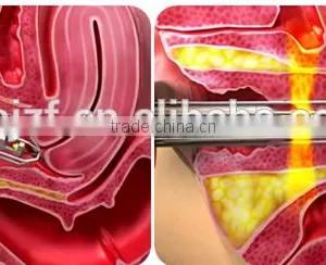 Face Lifting F7+ Fractional Co2 Skin Tightening Laser Equipment Vaginal Fractional Laser thumbnail-6