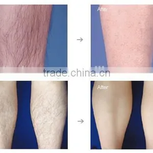 Spring in 2015 New Ipl Hair Removal Skin Rejuvenation System Machine thumbnail-6