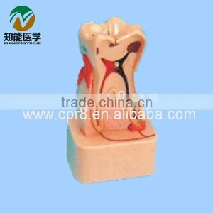 Teeth Lesions Comprehensive Pathological Decomposition Model BIX - L1004 thumbnail-1